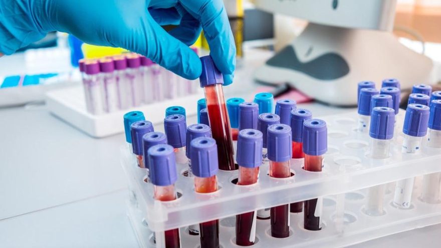 MCHC Nedir? MCHC Yüksekliği ve Düşüklüğü Ne Anlama Gelir?