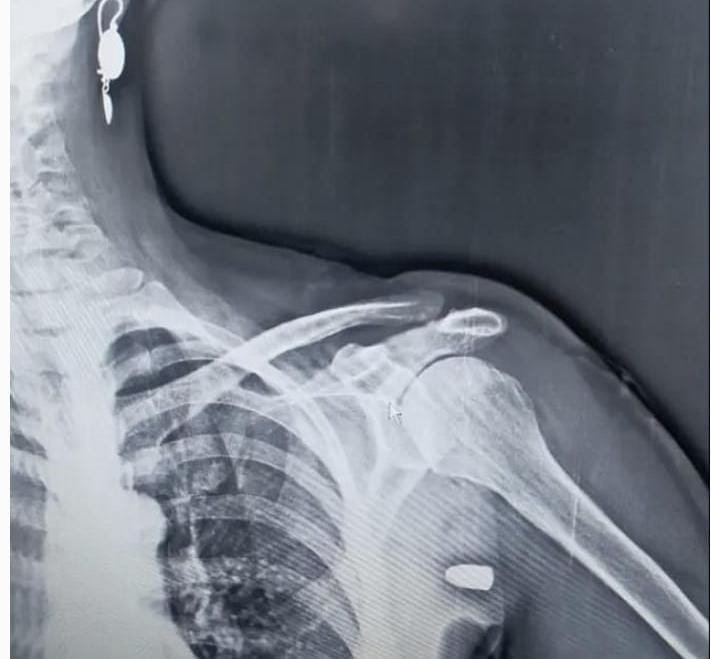 TRABZON’DA TÜM UYARILARA RAĞMEN YORGUN MERMİ VAKALARI BİTMİYOR. TONYA İLÇESİNDE SOL OMZUNA YORGUN MERMİ İSABET EDEN KADIN NEREDEYSE CANINDAN OLUYORDU