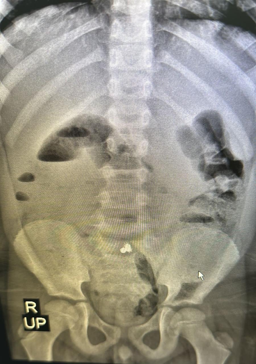 RİZE'DE KARIN AĞIRISI VE KUSMA NEDENİYLE GİTTİĞİ HASTANEDE ERKENDEN TEŞHİS EDİLEREK AMELİYATA ALINAN 7 YAŞINDAKİ MİRAÇ KALAY'IN YUTTUĞU MIKNATISLI DEMİR BİLYELERİN 3 YERDEN BAĞIRSAĞINI DELDİĞİ ORTAYA ÇIKTI
