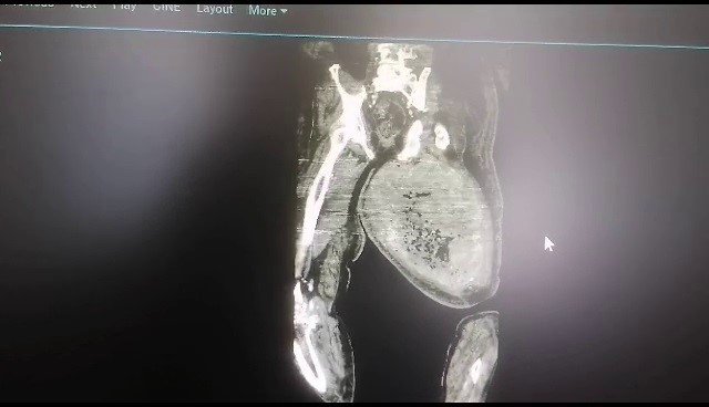 ÇORUM'DA AYAKLARINDAKİ AĞRI VE ŞİŞME SEBEBİYLE HASTANEYE GİDEN HAYDAR YATAR UYLUK KEMİĞİNDEN 8 KİLO 900 GRAM TÜMÖR ÇIKARTILDI
