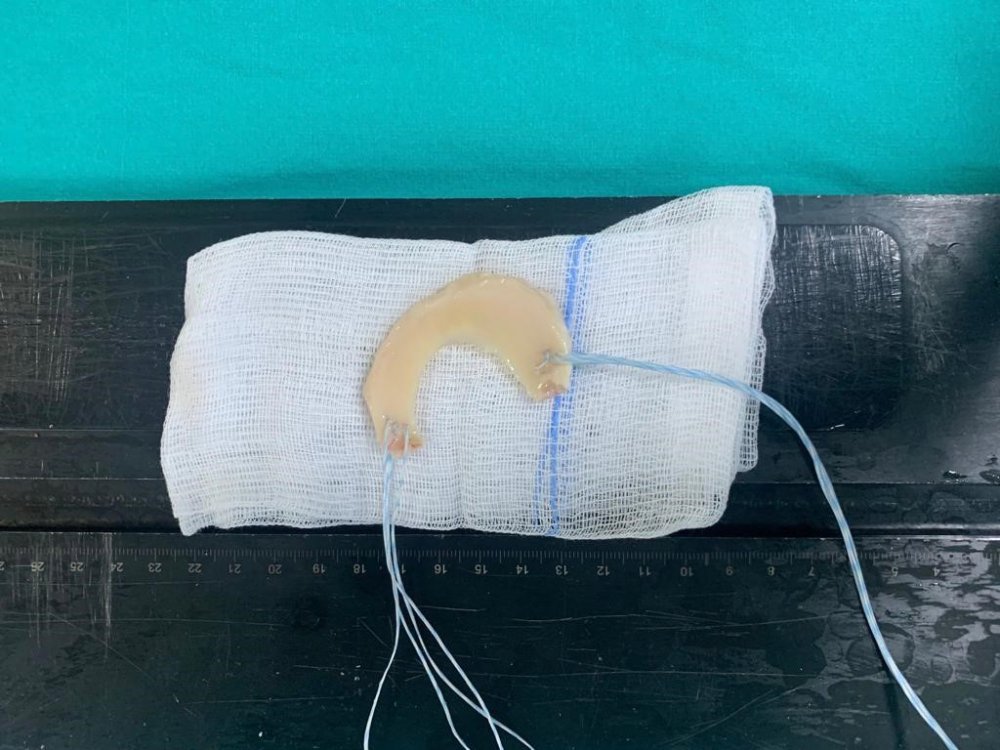 TÜRKİYE’DE DEVLET HASTANELERİNDE İLK: SAMSUN'DA 16 YAŞINDA HALI SAHADA ARKADAŞLARI İLE MAÇ YAPARKEN ÖN ÇAPRAZ BAĞLARI KOPAN 21 YAŞINDAKİ ENSAR USTA’YA ‘MENÜSKÜS NAKLİ’ YAPILDI