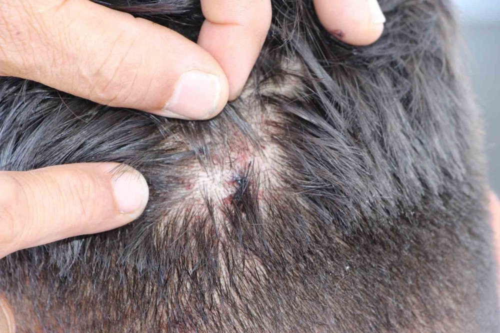 TRABZON’DA 8 YILDA YORGUN MERMİDEN 5 KİŞİ ÖLDÜ, 100’E YAKIN KİŞİ YARALANDI