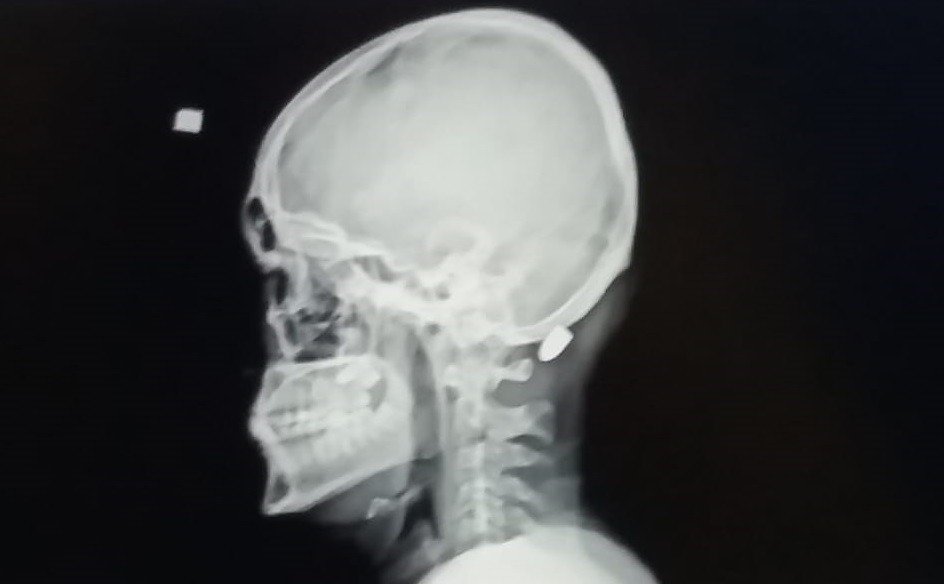 TRABZON’DA 8 YILDA YORGUN MERMİDEN 5 KİŞİ ÖLDÜ, 100’E YAKIN KİŞİ YARALANDI