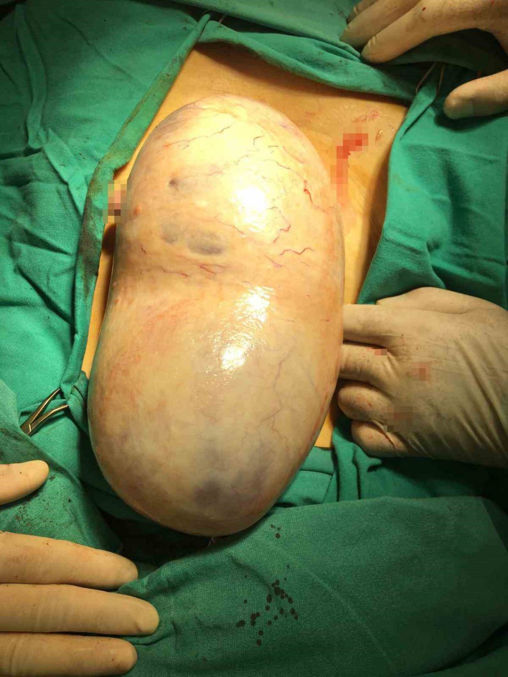 Hamile Kadının Karnından 2,2 Kiloluk Kitle Çıkarıldı, Cenin Ve Anne Kurtuldu