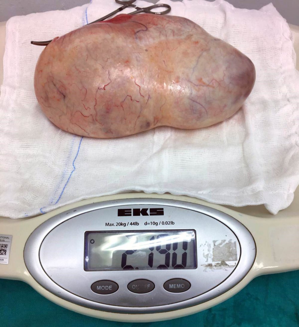 Hamile Kadının Karnından 2,2 Kiloluk Kitle Çıkarıldı, Cenin Ve Anne Kurtuldu