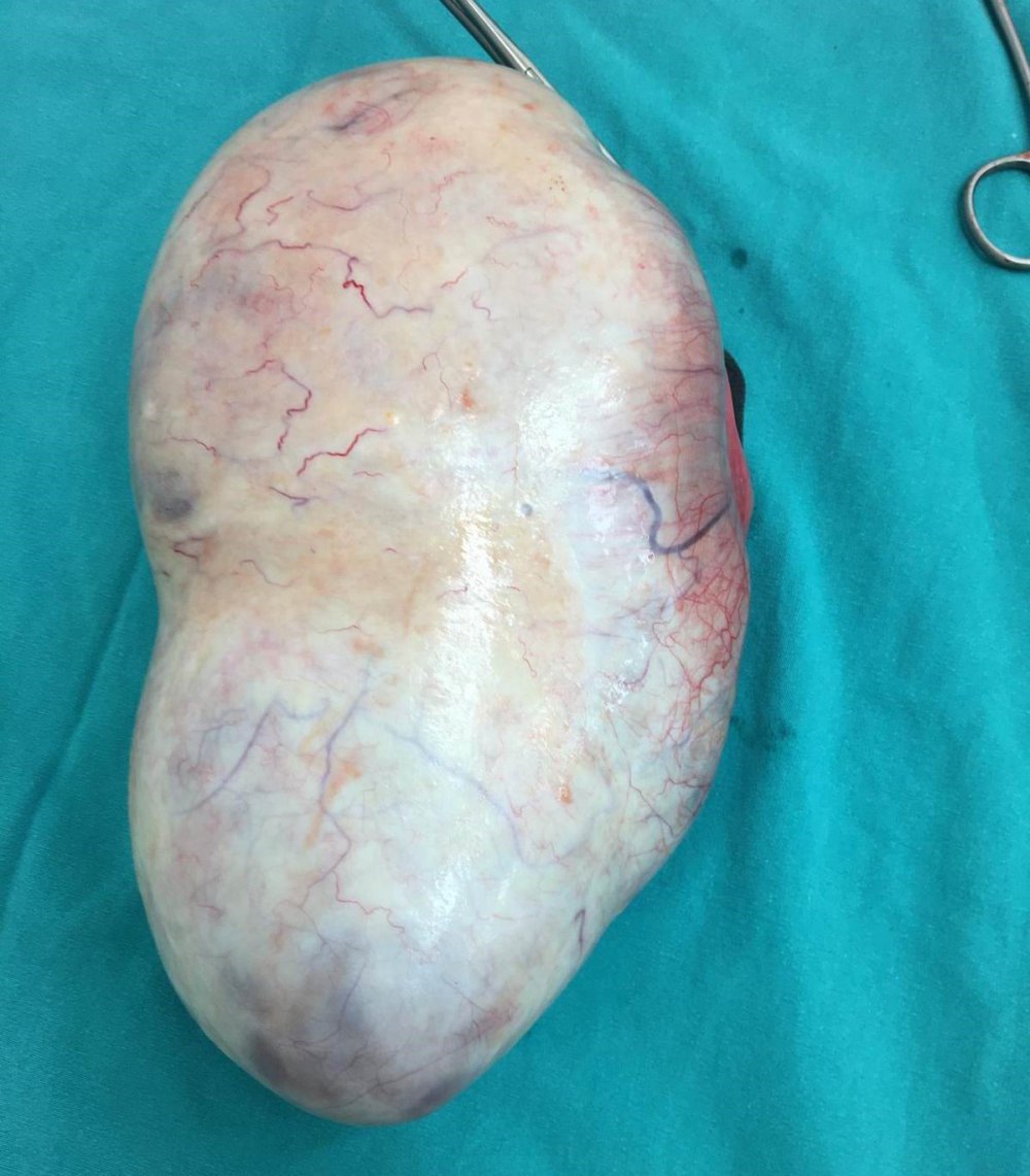 Hamile Kadının Karnından 2,2 Kiloluk Kitle Çıkarıldı, Cenin Ve Anne Kurtuldu